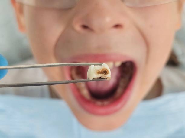 Best Emergency Tooth Extraction in Moline, IL
